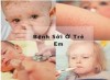 Bệnh sởi ở trẻ em