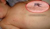 Bệnh sốt xuất huyết do virus Dengue gây ra, chủ yếu lây qua muỗi cái Aedes, đặc biệt là muỗi Aedes aegypti