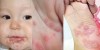 Dấu hiệu của bệnh tay chân miệng: xuất hiện mụn nước ở lòng bàn tay, lòng bàn chân, mông và bên trong miệng