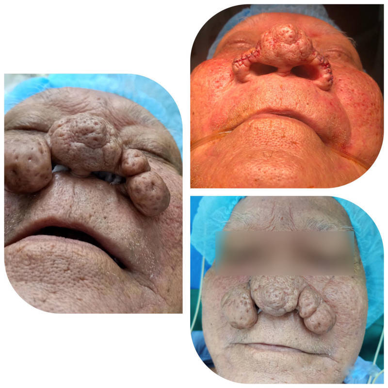 Bệnh nhân mắc bệnh mũi sư tử Rhinophyma hiếm gặp