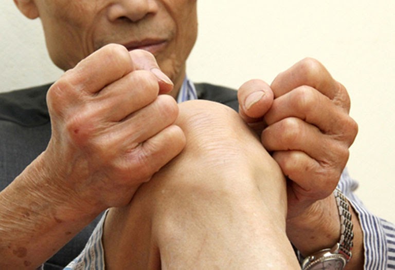Thoái Hóa Khớp: Nguyên Nhân, Triệu Chứng Và Cách Điều Trị Hiệu Quả [Đừng Bỏ Lỡ]