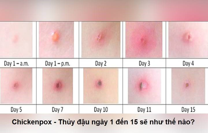 thủy đậu 2