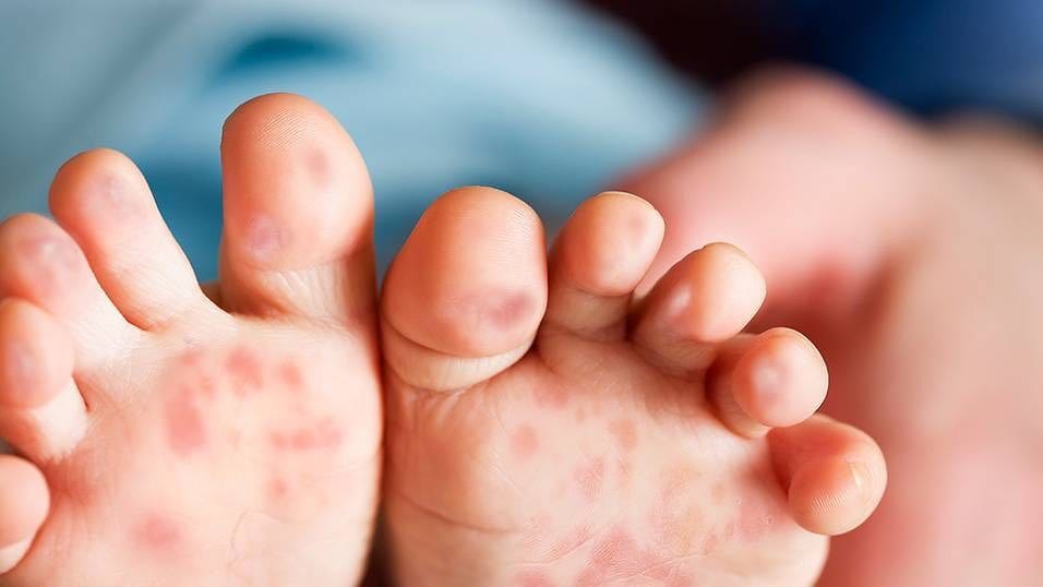 Ở giai đoạn toàn phát trẻ bắt đầu phát ban ở bàn chân