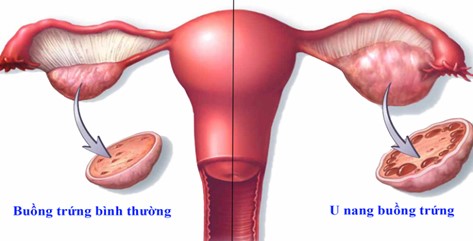 Phát hiện sớm u nang buồng trứng: Phụ nữ cần đi khám phụ khoa định kỳ