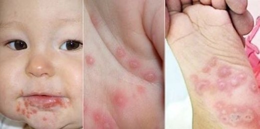 Dấu hiệu của bệnh tay chân miệng: xuất hiện mụn nước ở lòng bàn tay, lòng bàn chân, mông và bên trong miệng