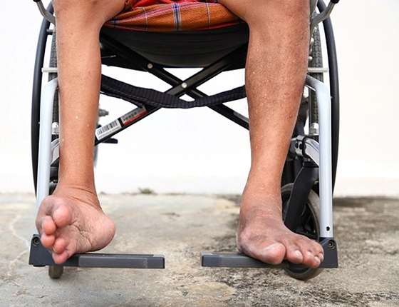 Trẻ em là đối tượng dễ mắc bệnh bại liệt, đặc biệt là trẻ chưa được tiêm vắc xin đầy đủ.